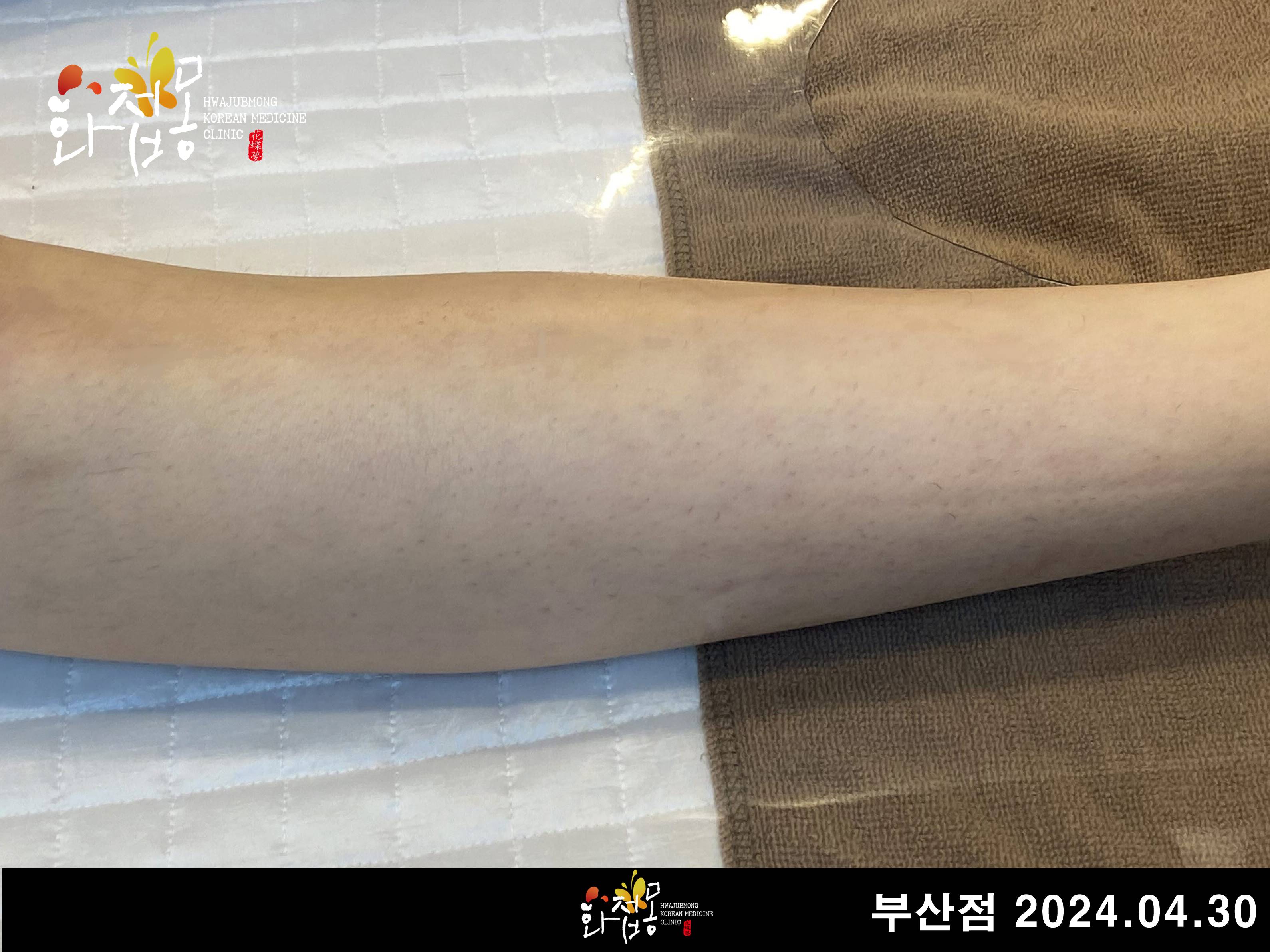 전후사진