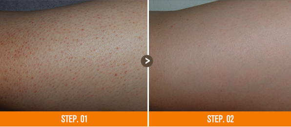 화접몽한의원 모공각화증 전후사진