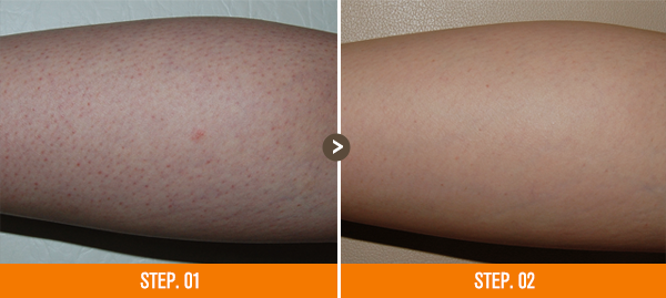 화접몽한의원 모공각화증 전후사진